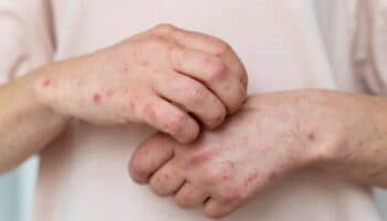 95% de los casos de sarampión son en Chihuahua, frontera con Estados Unidos: Salud