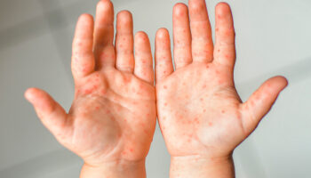 Reforzarán vacunación de sarampión y tos ferina por incremento de casos